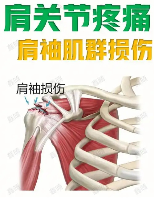 肩关节疼痛 - 肩袖损伤症状及并发症