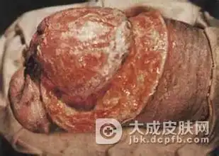 女性单纯性淋病的早期症状有哪些