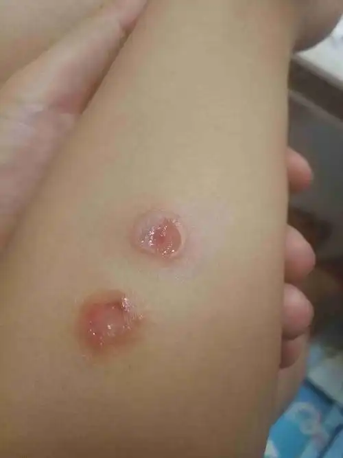一开始就是个小红点,两天就变成这样,周围都是水泡,一点点就变这样