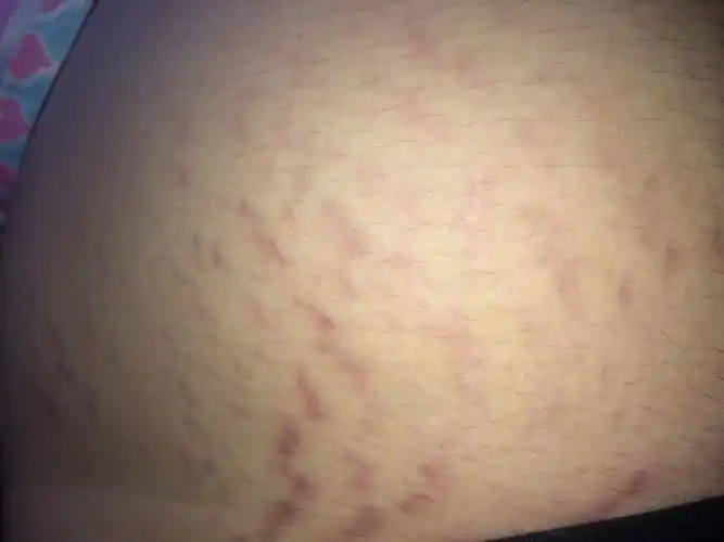 我老婆的大腿上,大腿上来一点的肚子上都长了这个