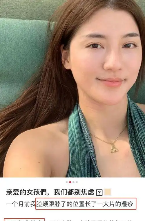 吴千语穿吊带秀美背脖子脸颊长湿疹称超痒自曝焦虑到睡不好