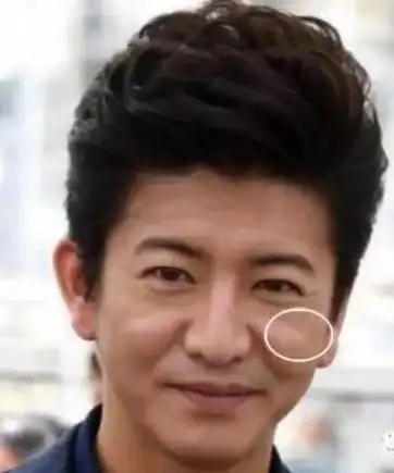 印第安纹图片是什么样的,泪沟凹陷严重都到脸颊了是印第安纹吗?_手机