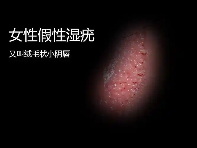 女性假性尖锐湿尤图初期图片