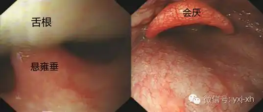 3,咽部到食管入口的操作:胃镜通过舌根后即可看到会厌软骨,动作轻盈时