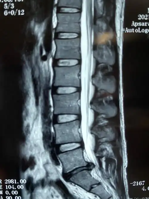 腰椎盘膨出治疗方法(腰椎盘膨出治疗方法有哪些) 腰椎