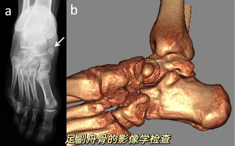 这就有可能是副舟骨,足的副舟骨是舟骨结节部第二化骨中心的先天异常