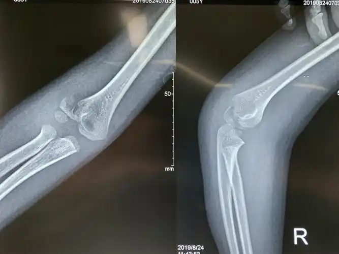 小儿胳膊骨折(肱骨外髁骨折) - 好大夫在线