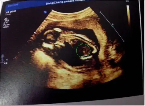b超图怎么看性别, 求高人帮忙看下下图是男孩还是女孩!