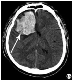 成人血友病同一脑叶7次出血病例报告