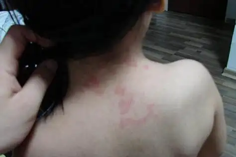 风疹是怎么引起的?日常如何做好风疹的防控