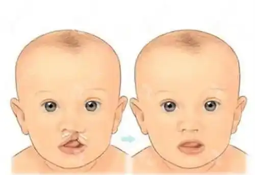 贵州利美康唇腭裂公益活动第八期唇裂修复免费救助在行动