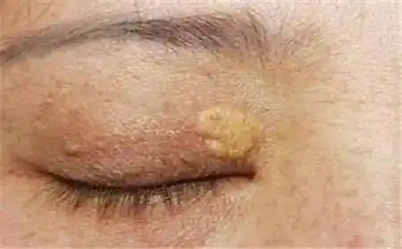 眼周"脂肪粒",你分清楚了吗?_汗管瘤_症状表现_治疗方式 - 好大夫在线