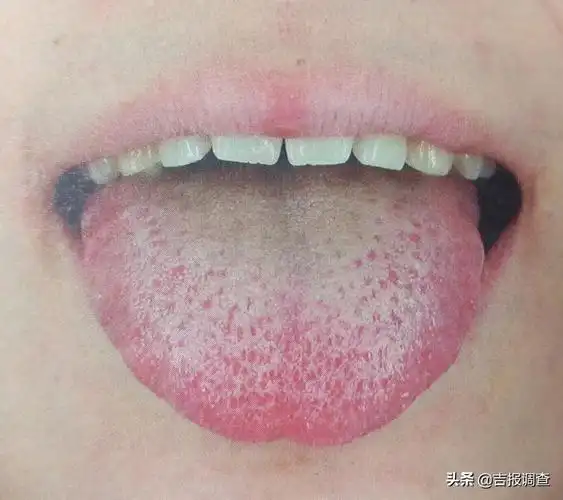边有齿痕气虚,湿气气虚体质的人舌头上多半会有齿痕