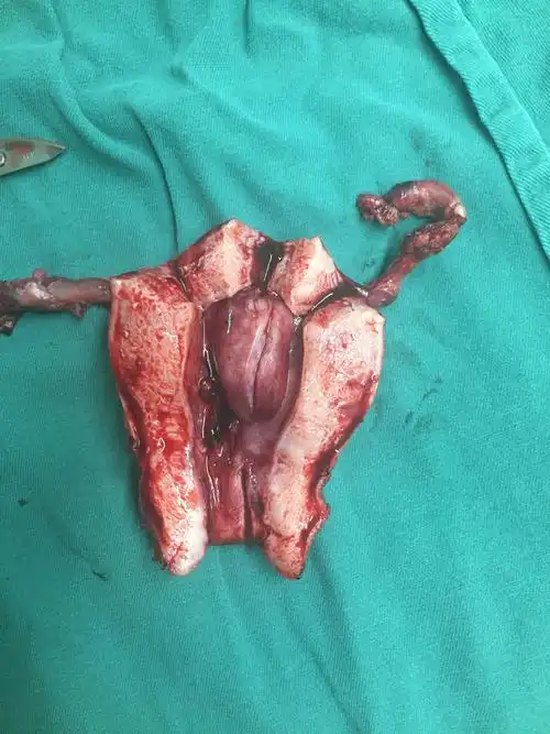 子宫内膜息肉 - 好大夫在线