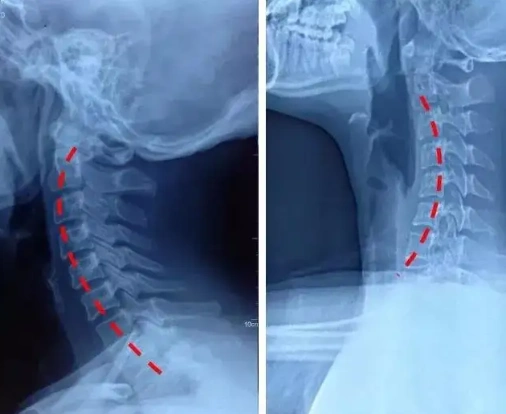 千万注意总低头看手机小心颈椎反弓