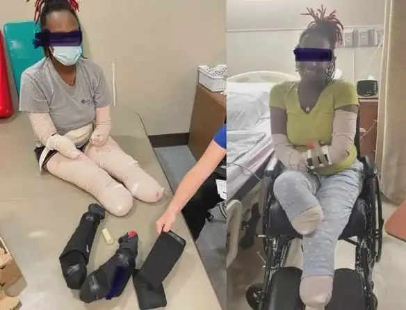 美32岁三宝妈染疫血栓惨被截去四肢她po照呼吁快去打疫苗