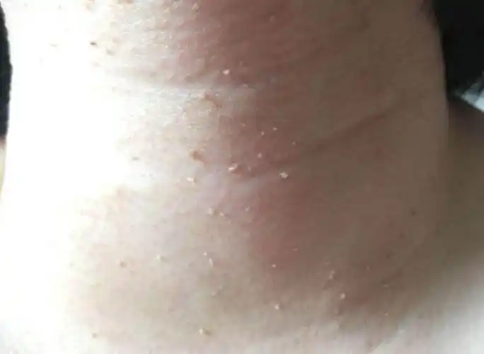 露脖季别让丝状疣毁了你的玉颈