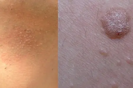 【图】脂肪粒和扁平疣的区别 相似病状需要小心对待