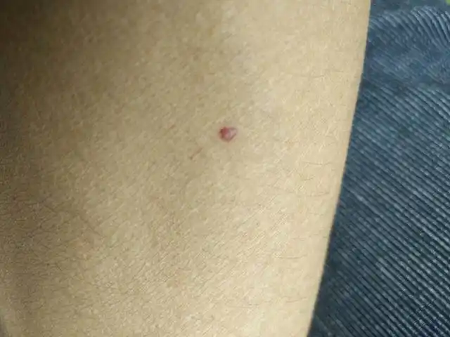 樱桃状血管瘤好发于30岁以上中老年人无传染性病因尚不明确