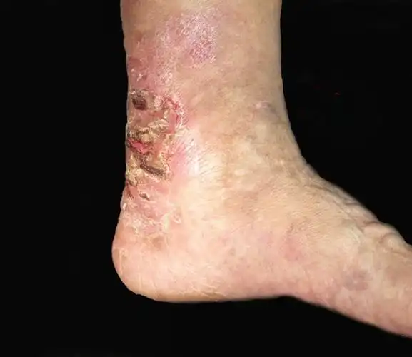 足底慢性湿疹图片_有来医生