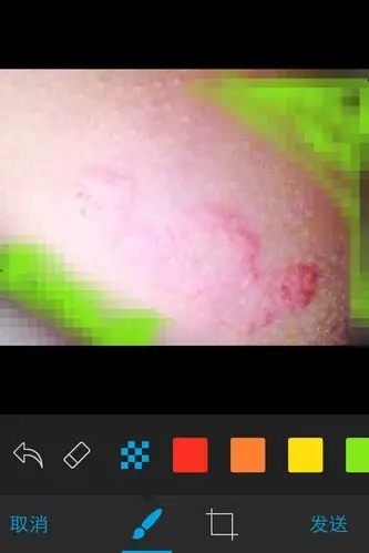 怀孕五个多月身上长真菌感染的癣对胎儿有影响吗