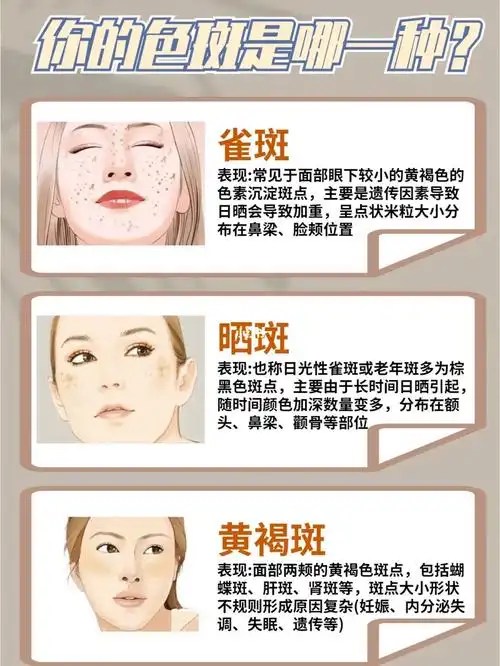 教你认清自己的斑点99斑点科普7575757575