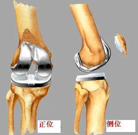 全膝关节置换术怎么做