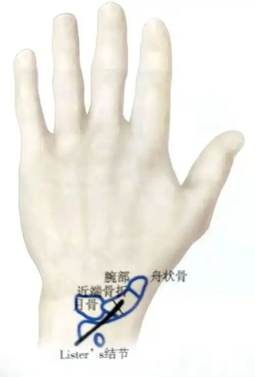 舟状骨骨折固定方案详解看完的人都收藏了