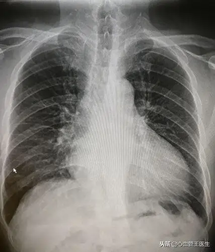 高血压没有不舒服不代表没有危害,一旦发生心衰,很难逆转,等待的就是