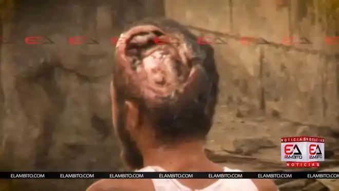 蝇蛆病哥伦比亚流浪汉头部被4000条蛆虫吞噬到头骨外露