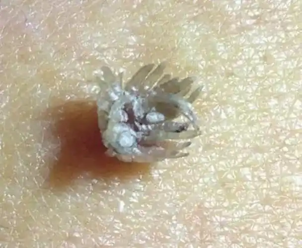 女性尖锐湿疣早期图片_有来医生