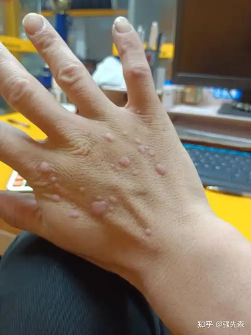 有没有治疗扁平疣的好方法来一个