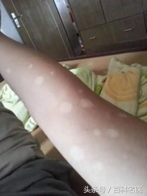 其实他这是汗斑,又叫花斑癣,花斑糠疹,是由马拉色菌引起的皮肤浅表的