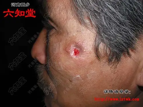 皮脂腺囊肿粉瘤被中医治愈病例