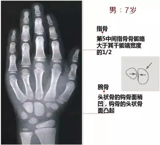 男孩骨龄图谱女孩骨龄图谱上图中的数字为相应骨时的年龄青春期和以后