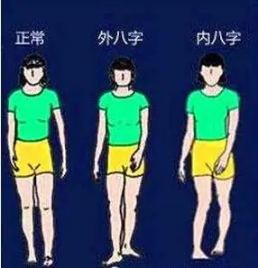 螃蟹型(外八字)这么走路乍看之下背脊挺得很直,显得有精神,但仔细观察
