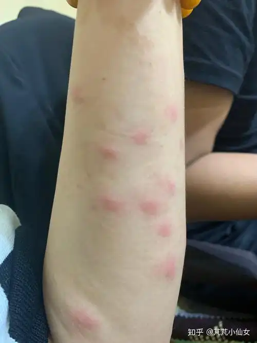 丘疹性荨麻疹治疗过程 - 知乎