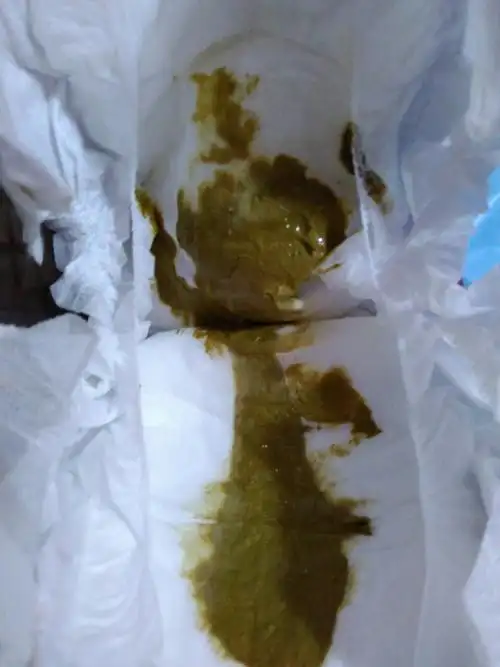 宝宝拉这样的屎正常吗