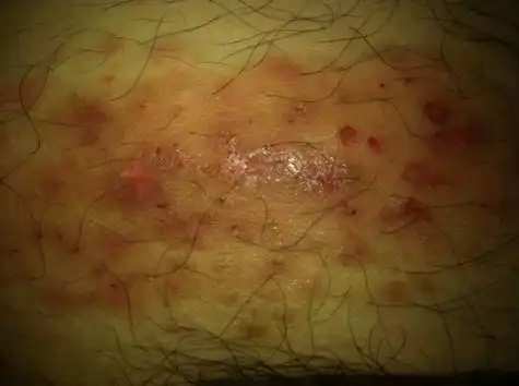 与周围皮肤颜色相似,不痛不痒,虽然对排尿性生活均无影响这种龟头红点