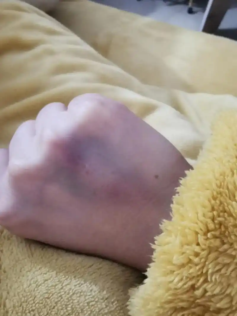 0101两个手打针都打肿了,感冒都还没有好……难受 如果有人 - 抖