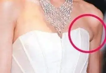 副乳究竟是什么18岁少女腋窝长个小包块最后竟要动手术