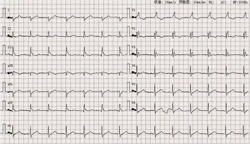 心电图图库丨左后分支阻滞系列