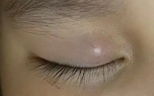 眼睑常见疾病--霰粒肿