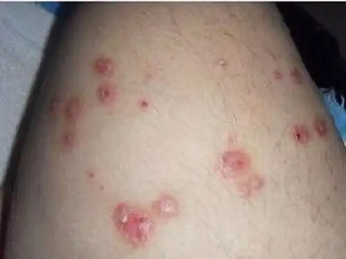 血热引起的皮肤病血热是一种人体内源性发热症状,由于血液加速或血力