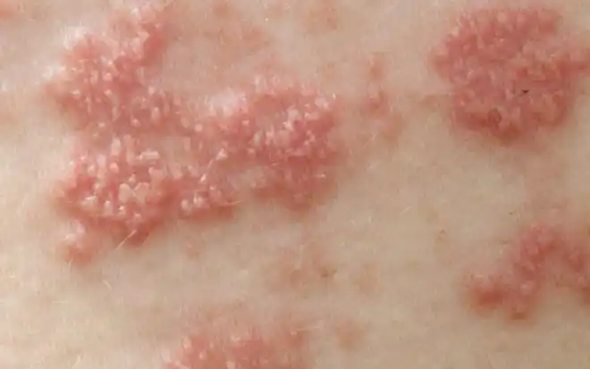 女人感染hpv,脸上会有2处"提示",医生:不妨多留意|宫颈|病毒|子宫