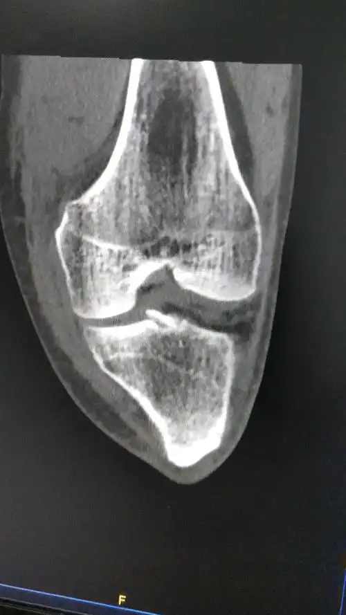 胫骨平台髁间嵴骨折