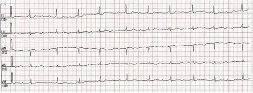 心电图解读房性心动过速伴病理性房室阻滞