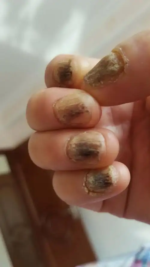 我十个手指患了一种像灰指甲的一种病,但是医生诊断不是灰指甲.