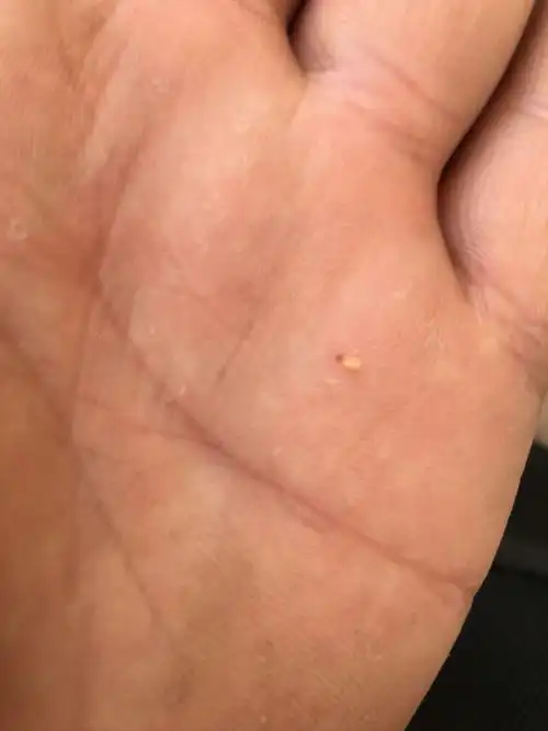 我想知道我的脸上为啥小痘痘不断,用手挤会挤出白色脂肪颗粒,有的时候