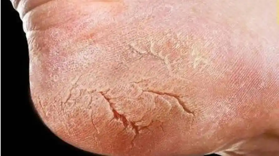 冬季脚后跟皲裂,瘙痒,皲裂膏解决!_皮肤_治疗_效果